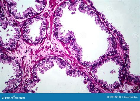 Prostate Cancer, Light Micrograph Stock Photo - Image of carcinoma, morphological: 183177192