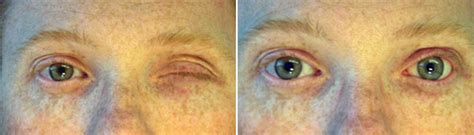 Patient of ocular prosthetics before and after photos.