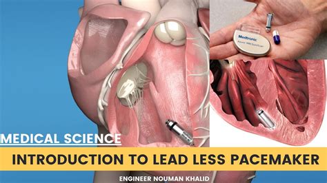 Introduction to leadless pacemaker and comparison with conventional ...