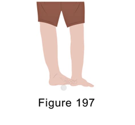 Metatarsalgia Exercises - Sinew Therapeutics