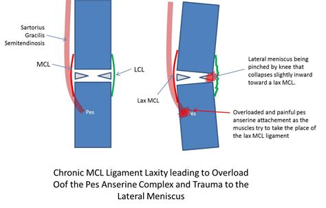 Knee Inside Pain: The Tennis Elbow of the Knee