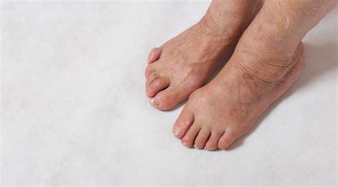 Claw Toes sign of underlying diabetes, says doctors | Health News - The ...