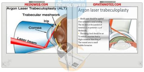 Argon laser trabeculoplasty - Meduweb