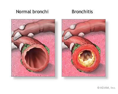 Bronchitis - Acute - Symptoms, Diagnosis, Treatment of Bronchitis ...