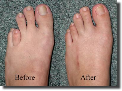 San Diego Podiatry Group | Brachymetatarsia in San Diego