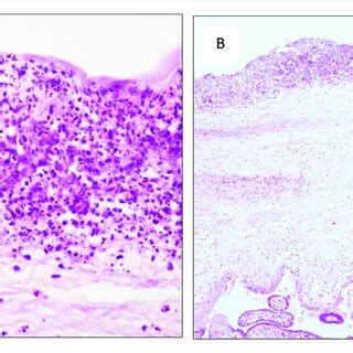 A: Acute chorioamnionitis stage 3 grade 2 (400× haematoxylin and eosin ...