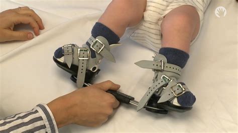 Clubfoot Stretches | Ponseti Brace | Module 4 - YouTube