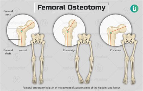 Femoral osteotomy: Procedure, Purpose, Results, Cost, Price