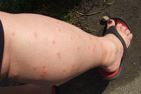 6 (Mostly) Natural Ways to Prevent Mosquito Bites