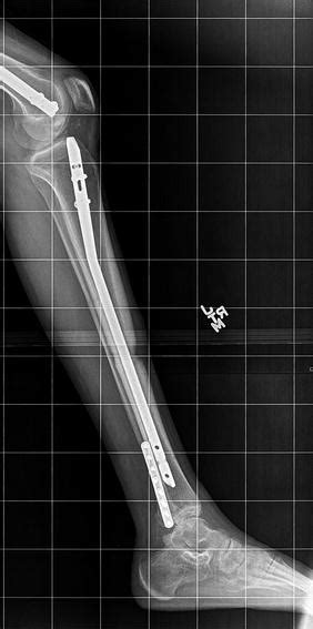 76: Equinus Contracture Correction with External Fixation | Plastic ...