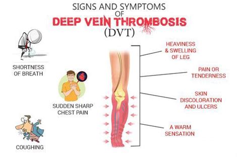 Deep Vein Thrombosis or DVT | Getcured Apothecary Pvt Ltd