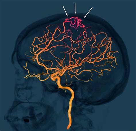 Brain Vascular Abnormality Photograph by Zephyr/science Photo Library