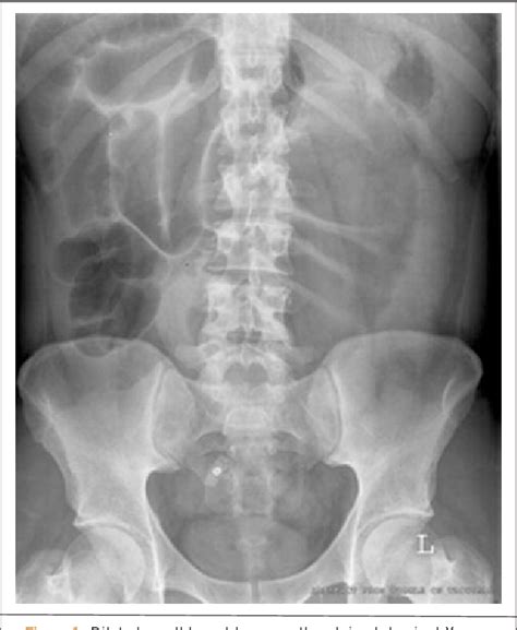 Figure 1 from Reversed rotation of the midgut in adults--a case report ...