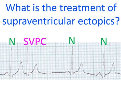 What is the treatment of supraventricular ectopics? - All About Heart And Blood Vessels