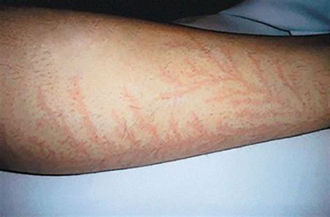 Incredible photos reveal what happens to your SKIN if you're struck by lightning - Mirror Online