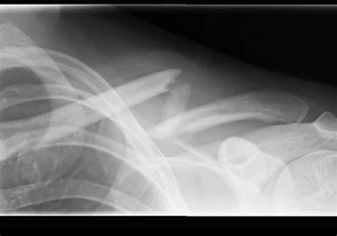 COSM | Clavicle (collar bone) fracture repair – ORIF