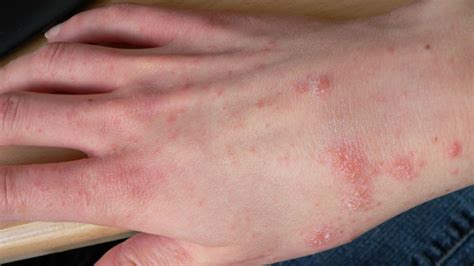 Natural Treatments for Scabies | Dermveda
