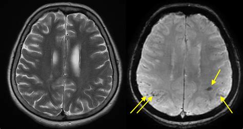 Cerebral Amyloid Angiopathy - MRI - Radiology at St. Vincent's University Hospital