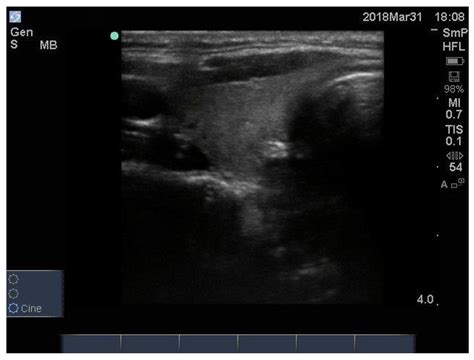 Normal Thyroid Ultrasound