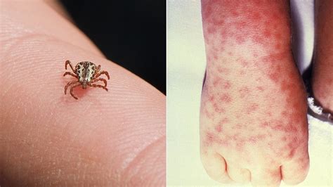 7 Tick Bites that Can Make You Sick | Everyday Health