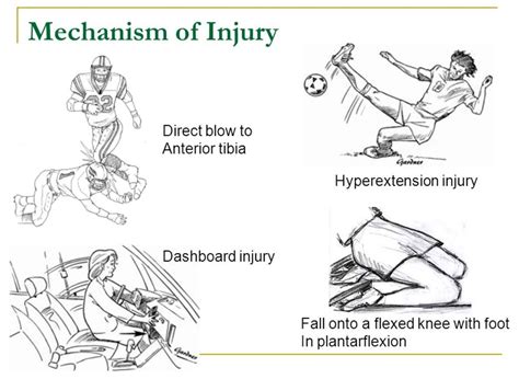 4 common PCL injury mechanisms and what to do and not to do about it?