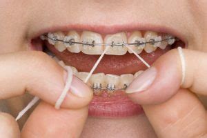 Do Braces Leave White Spots on Teeth? - Soleil Orthodontics