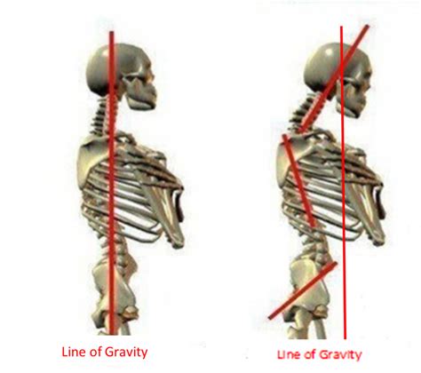 Deep Dive into Forward Head Posture - The Pettibon System