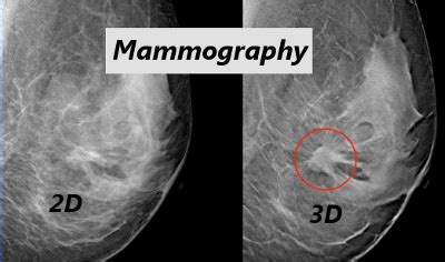 Mammogram | Breast Cancer