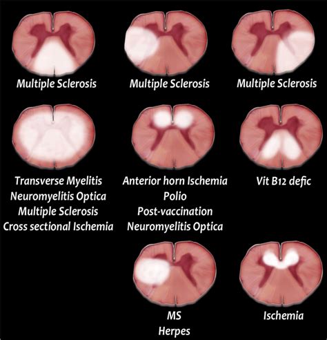 Spinal Cord Lesions