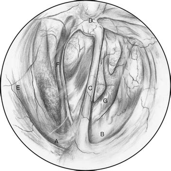 Disorders of the Guttural Pouch | Veterian Key