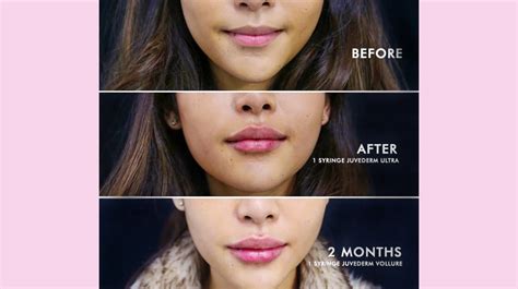 Which Better Restylane Vs Juvederm Lips - Healthy Anozo