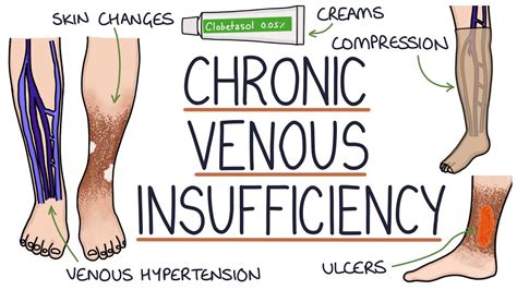 Understanding Chronic Venous Insufficiency - YouTube