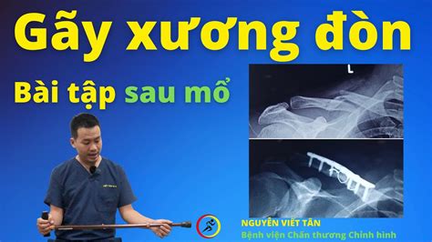 Những hình ảnh gãy xương đòn đáng sợ mà bạn không nên bỏ qua