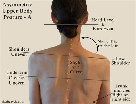 OMG! I LoVE this site! Overcoming Chronic Neck Pain: Postural Causes and A Unique Exercise Fix ...