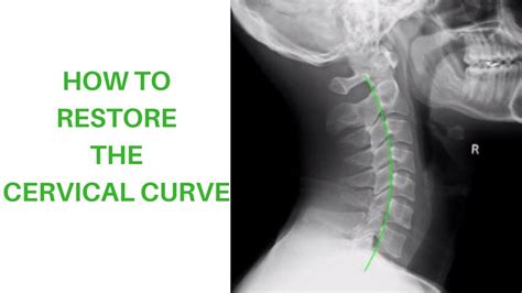 How To Restore The Cervical Curve - YouTube