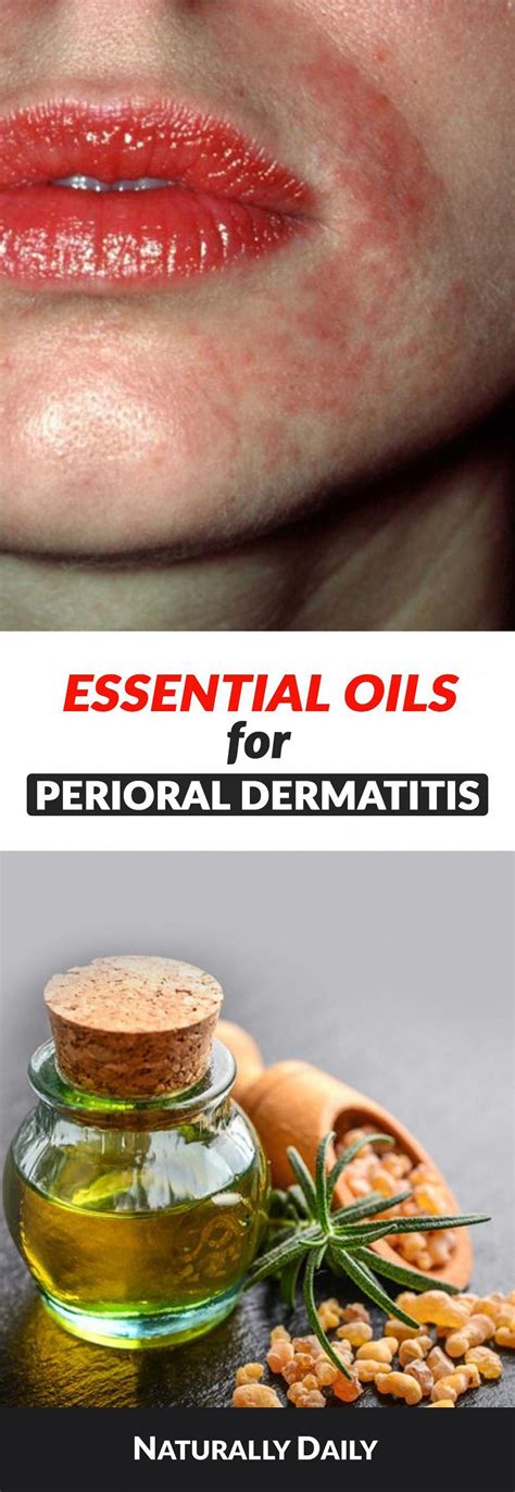 Perioral dermatitis is a very common inflammatory facial skin disorder and i… | Perioral ...