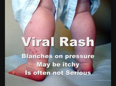 How To Check Meningitis Rash - YouTube