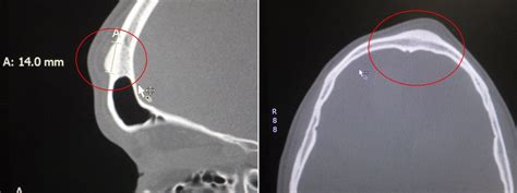 Forehead Osteoma Removal Richmond VA | Endoscopic Osteoma Removal