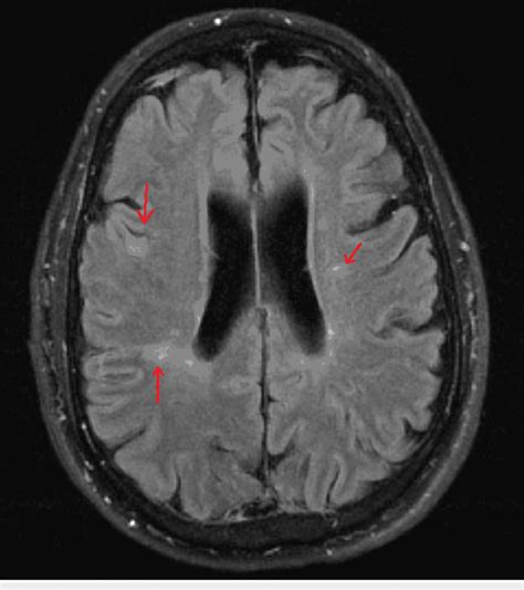 Bilateral T2-FLAIR periventricular and deep white matter signal... | Download Scientific Diagram