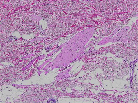 Acquired smooth-muscle hamartoma