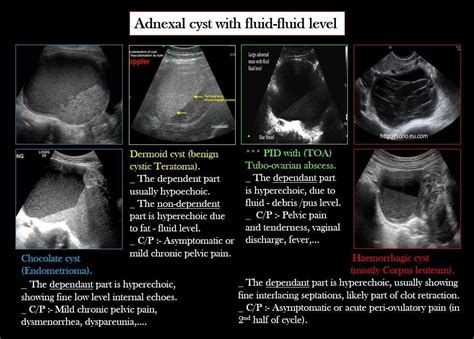 Pin by Stelios Daskalogiannis on adnexa adnexa | Medical ultrasound ...