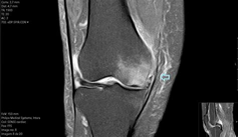 Cureus | Beyond Gonarthrosis in the Elderly: A Case Report of Subchondral Insufficiency Fracture ...