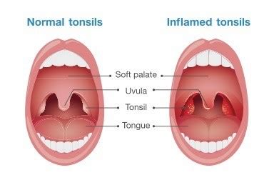 Tonsillitis: Causes, Symptoms and Treatment