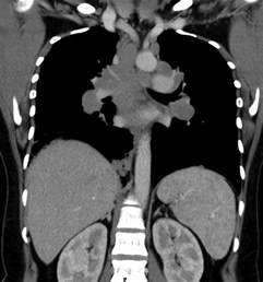 Enlarged Lymph Nodes Tonsils Abscess Tonsilectomy Periodontal V Alert | Porn Sex Picture