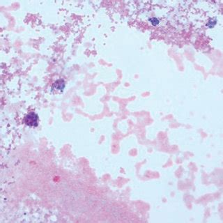 (a) Pleural and pericardial fluid cytology (10x) shows mesothelial ...