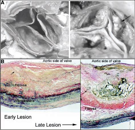 Figure 3 from Cellular Mechanisms of Aortic Valve Calcification ...