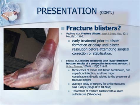 PPT - ANKLE FRACTURE PowerPoint Presentation, free download - ID:1901689