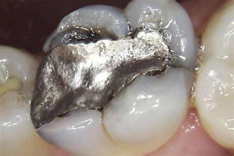 Cracked tooth syndrome - amalgam replacement - Rhondium Dental