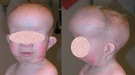 Gorlin syndrome causes, symptoms, diagnosis, treatment & life expectancy