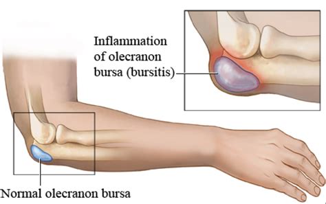 What is Bursitis? Why is it so Painful? And What can be done about it?